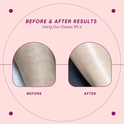 Portable Laser Hair Removal Machine Lightweight CO2 Device for Face & Body