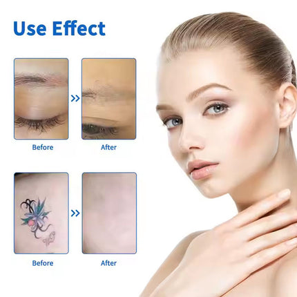 Portable Picosecond Laser Tattoo Removal Machine 532nm 1064nm Carbon Peel Salon Device