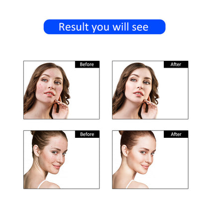 RF Facial Lifting Wand for At-Home Skin Firming & Anti-Aging Care